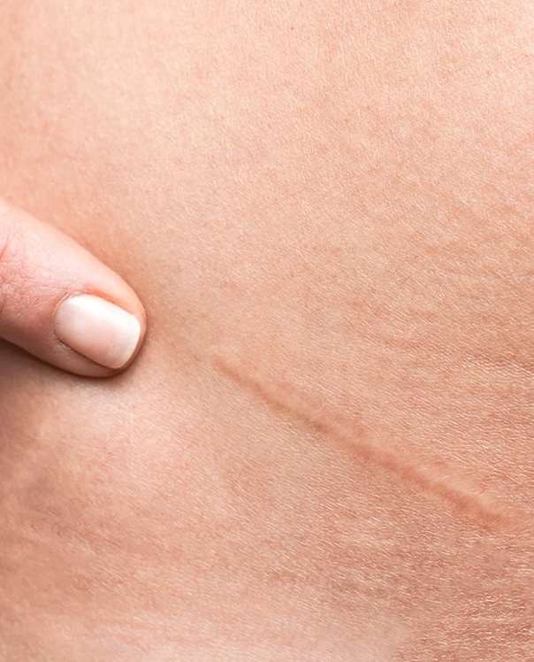 Close-up of a healed scar on skin with a finger gently touching it Close up of a healed scar on skin with a finger gently touching it