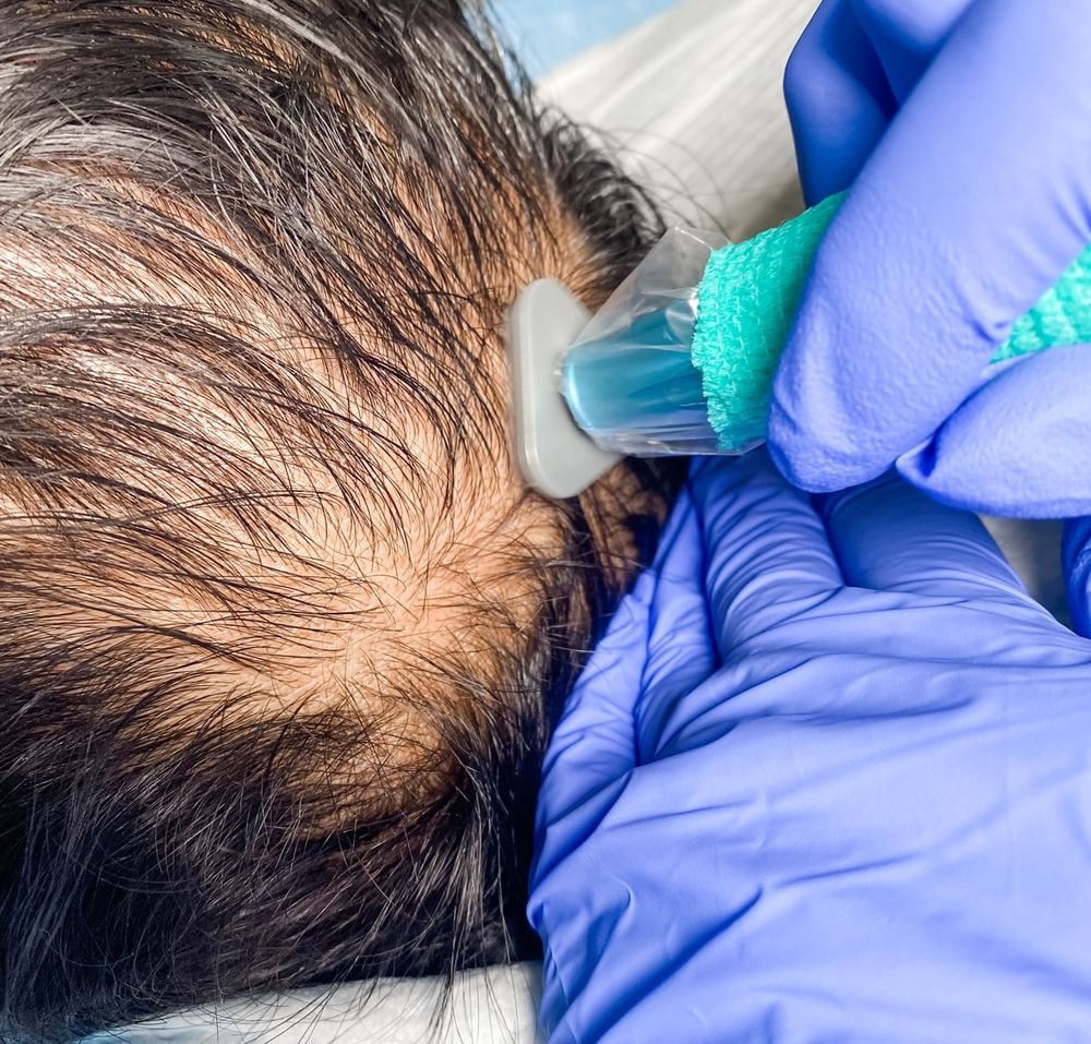 Close-up of scalp treatment using a microneedling or infusion device Close up of scalp treatment using a microneedling or infusion device