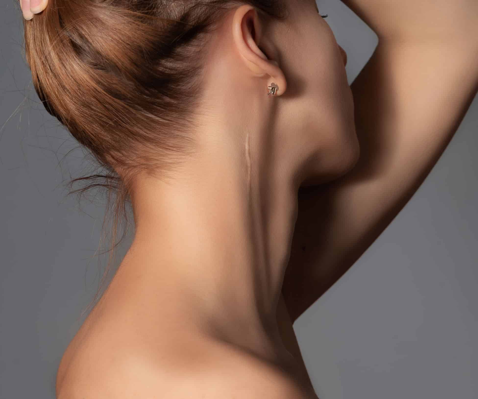 Scar-Treatment-Naples Scar Treatment Naples 1
