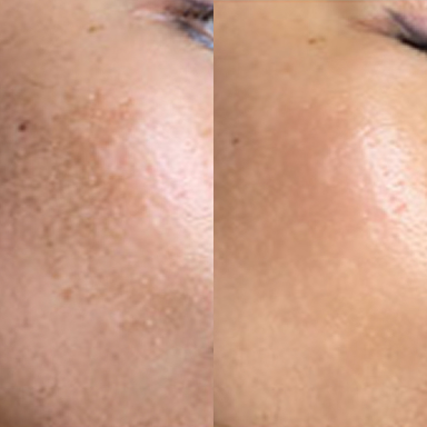 before after 1 before after 1